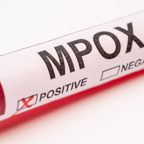 Un nou caz de mpox în Regatul Unit, fără legături de călătorie